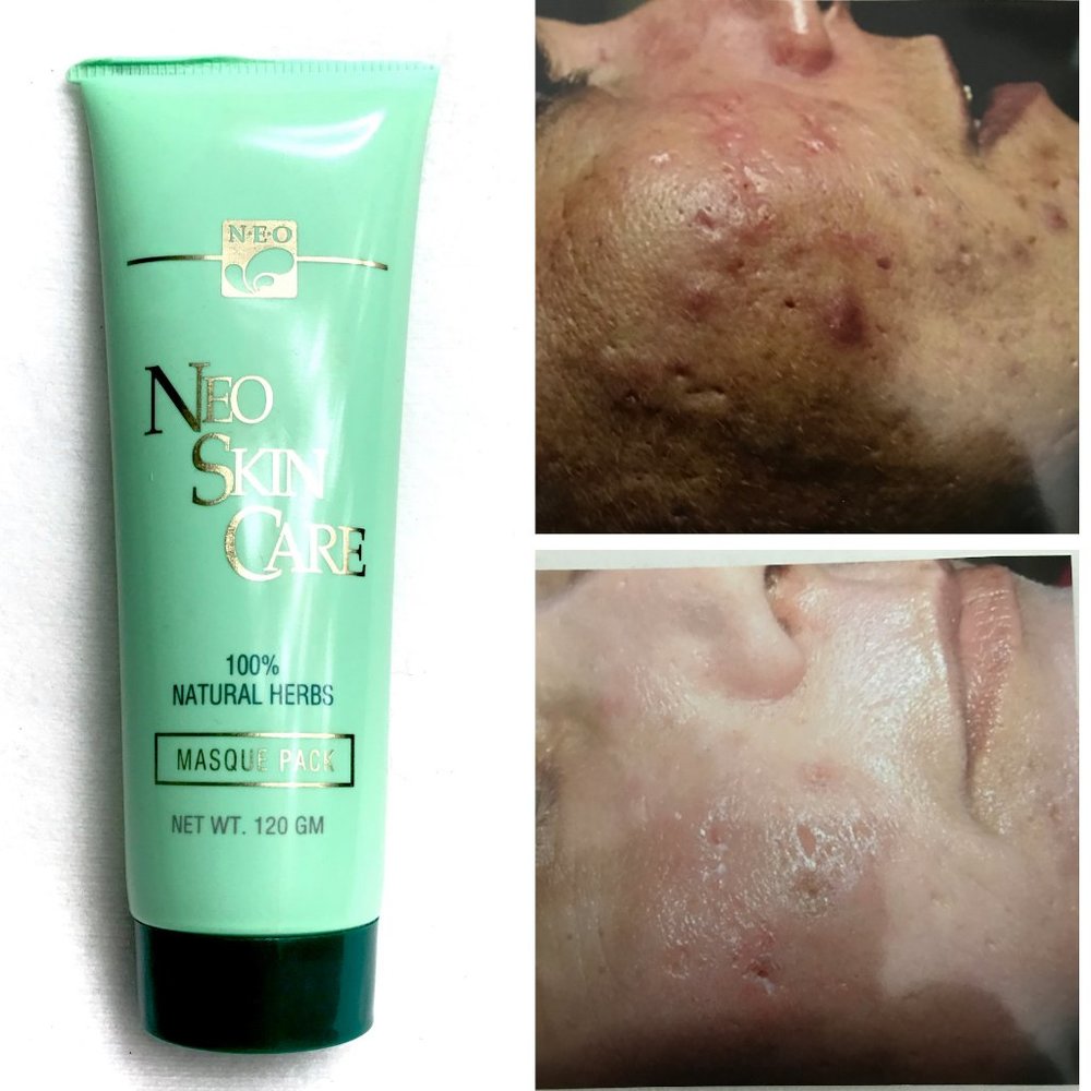 NEW BEST NATURAL HERBS MASK FOR ACNE & PROBLEM